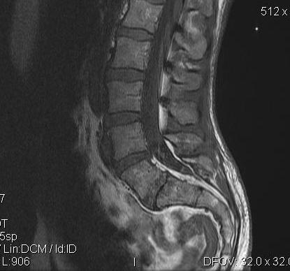 Isolated L5 S1 Disc Degeneration